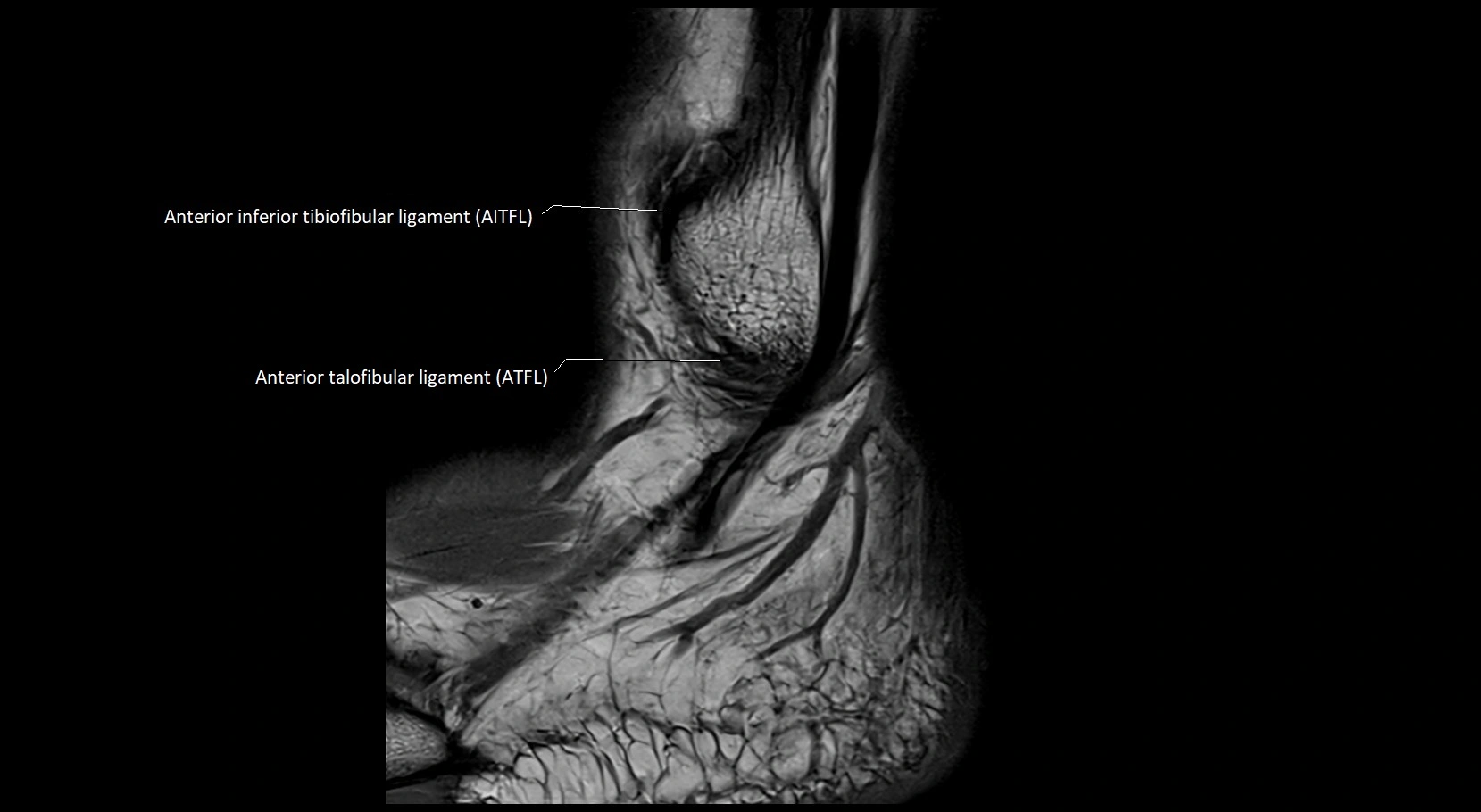 MRI ankle ligaments anatomy sagittal 3T image 26.webp